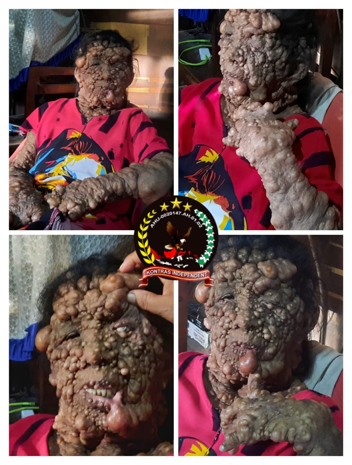 Menderita Penyakit Langka, Nelliati Dan Keluarga Butuh Uluran Tangan !