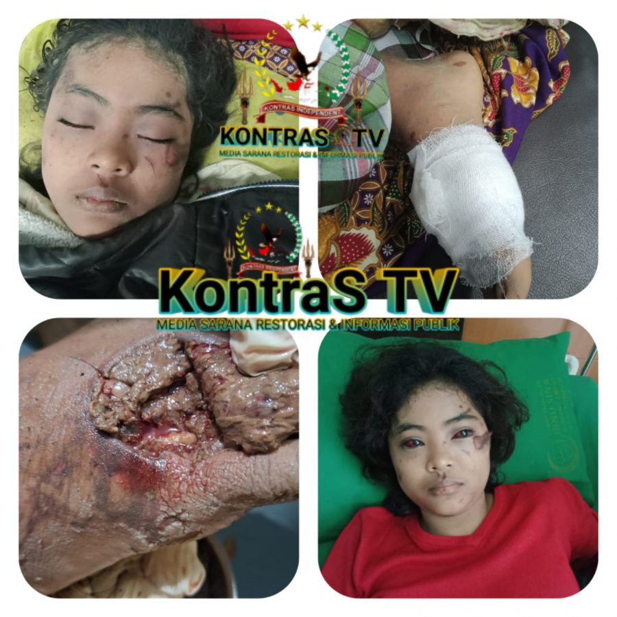 Ulurkan Tangan, Buka Donasi untuk Biaya Pengobatan Korban Galodo